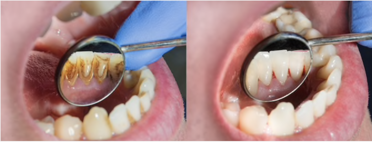 doença periodontal 