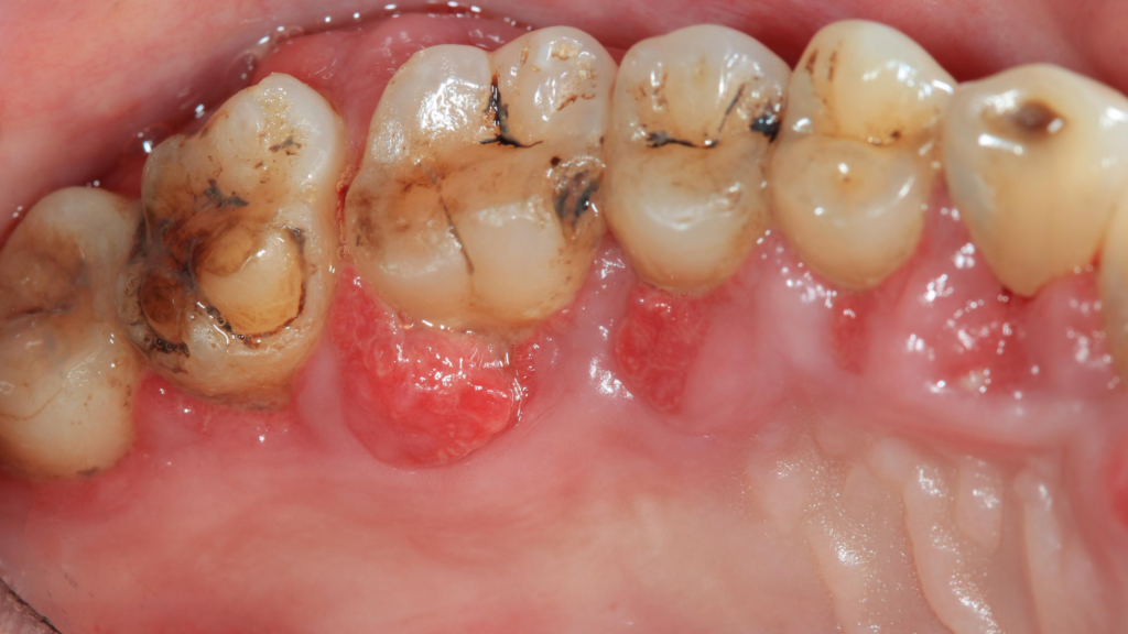 periodontite 