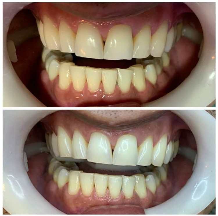 clareamento dental antes e depois
