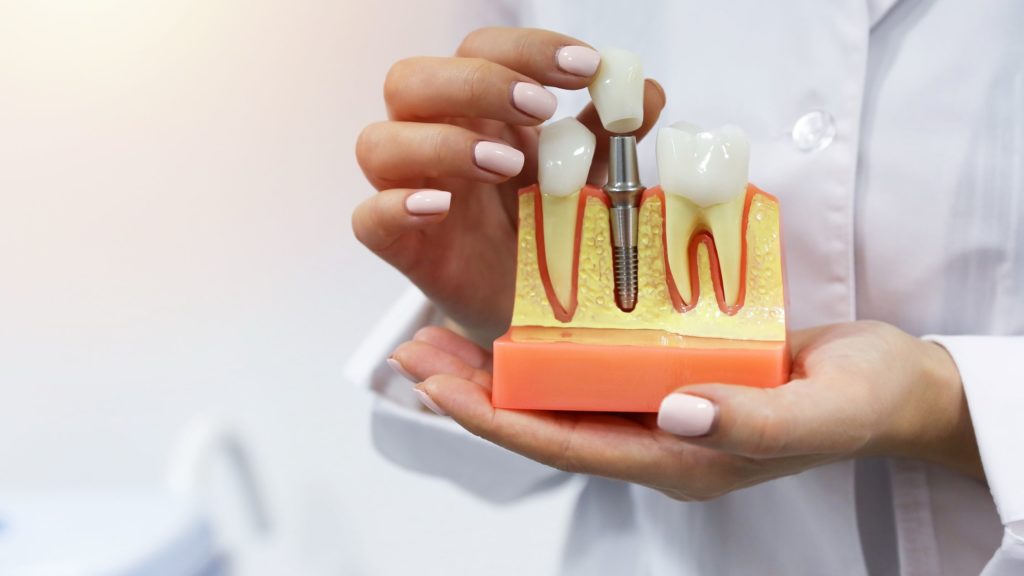 Conheça as principais técnicas de reabilitação com implante dentário