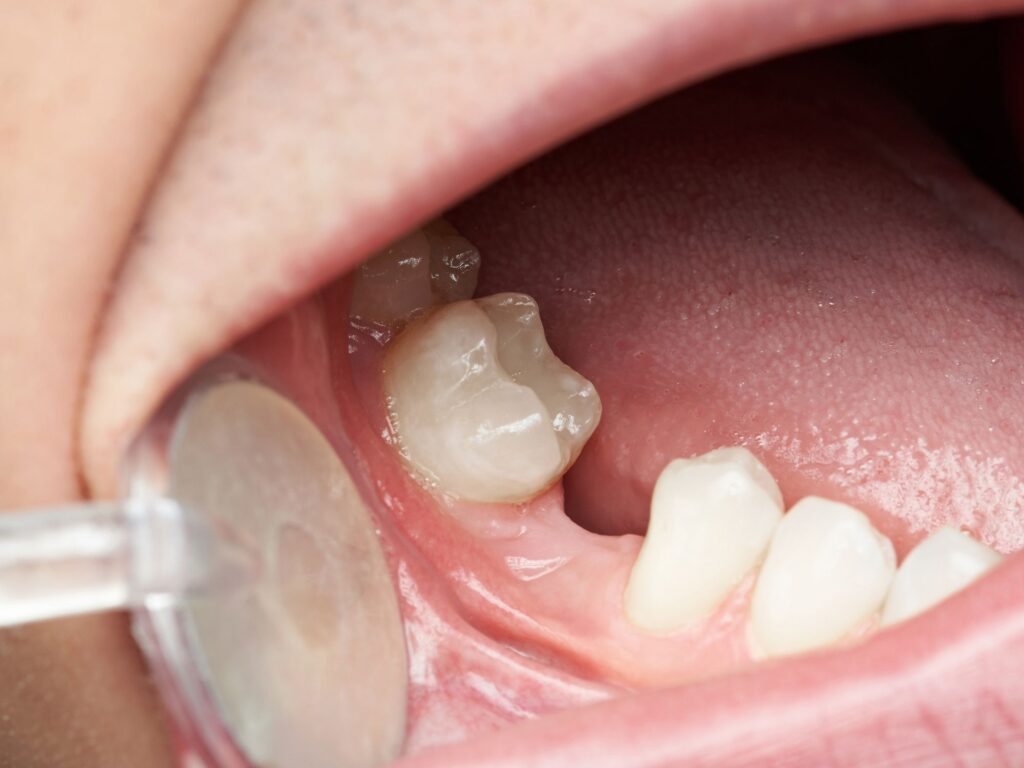 Edentulismo: Como Lidar Com A Perda De Dentes